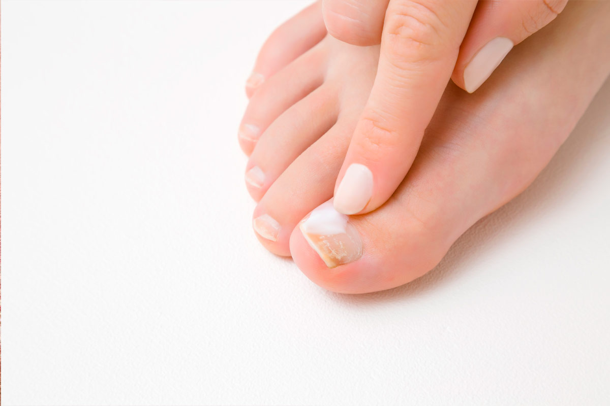 Tratamiento de Hongos en uñas y pies